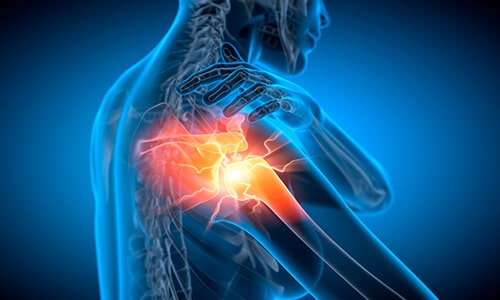 Inflamation Inflamation